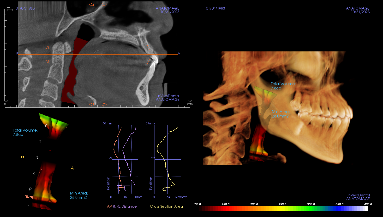 呼吸道電腦斷層