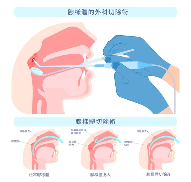 扁桃腺肥大切除與兒童OSA_3