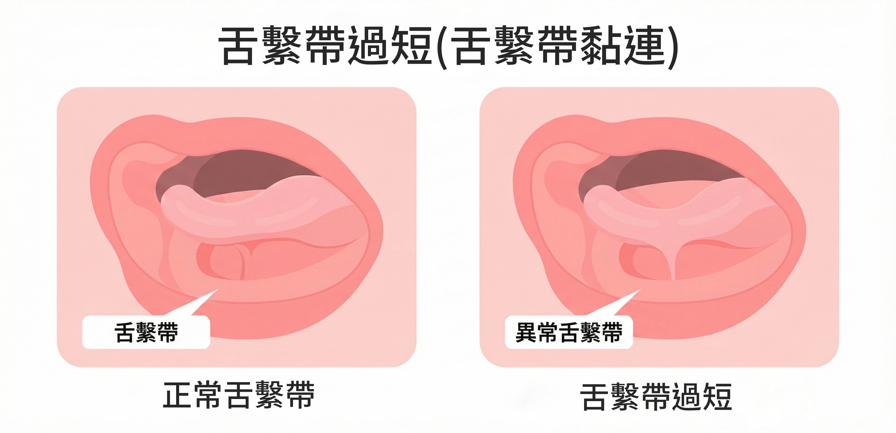 正常舌繫帶過短