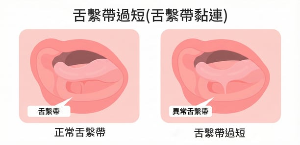 正常幼兒 vs 舌繫帶過短