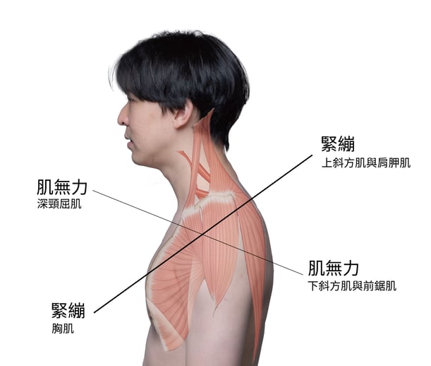 上交叉症候群-2