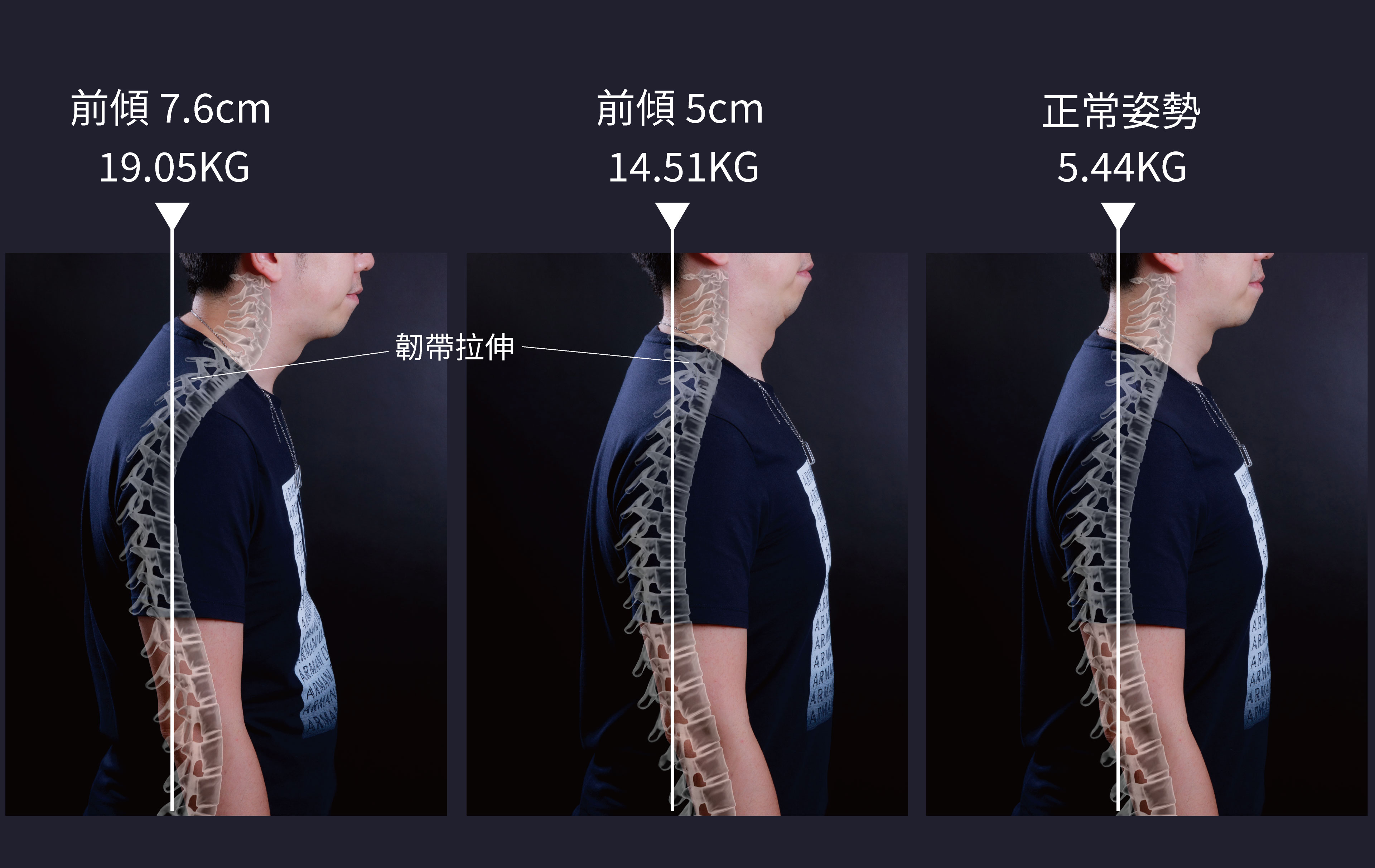 烏龜頸下巴不見