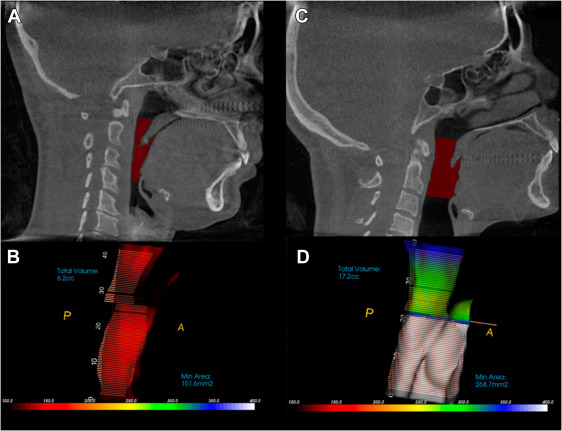烏龜頸打開呼吸道