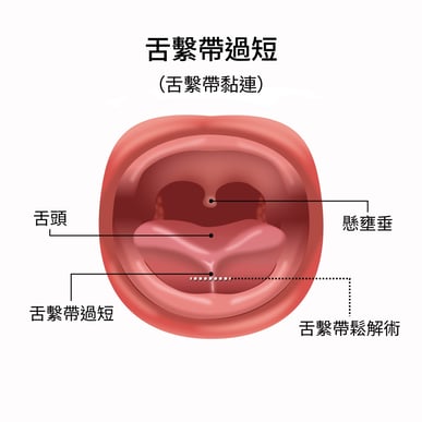 舌繫帶過短_兒童