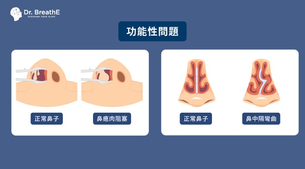 打呼 結構原因