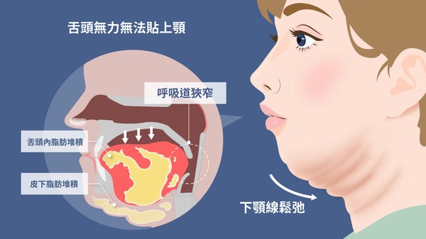 舌頭無力無法貼上顎