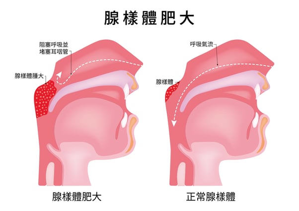 腺樣體肥大