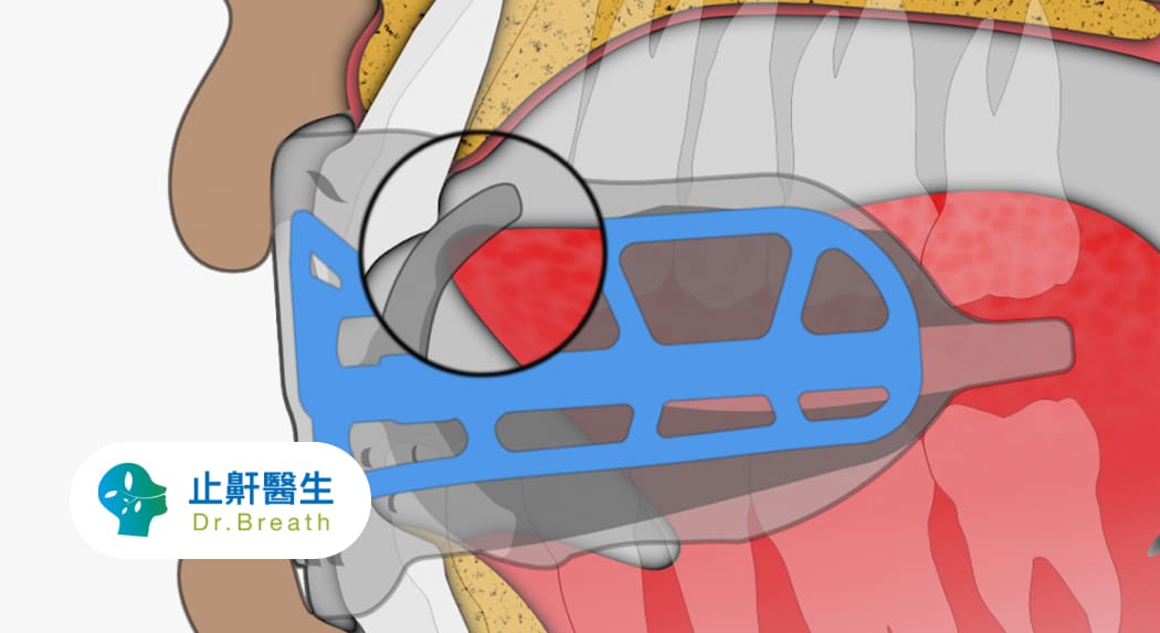 口腔肌功能訓練有助改善睡眠呼吸中止症