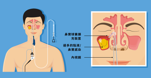 Endoscopic Sinus Surgery