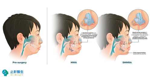 Maxillomandibular Advancement Surgery