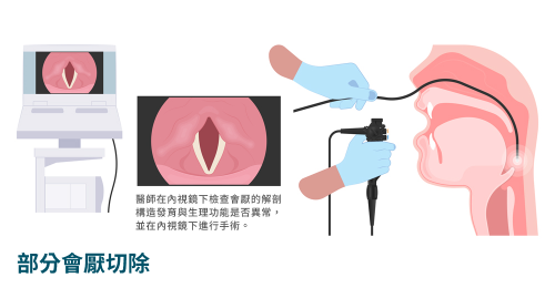 Partial Epiglottidectomy