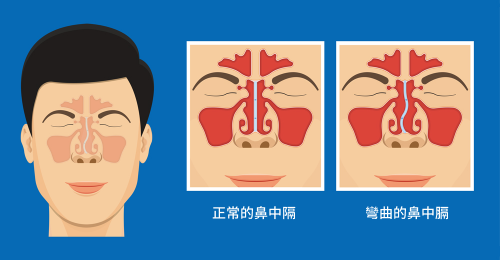 Septoplasty