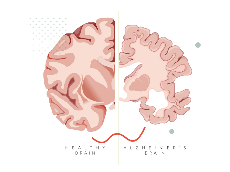 dementia brain